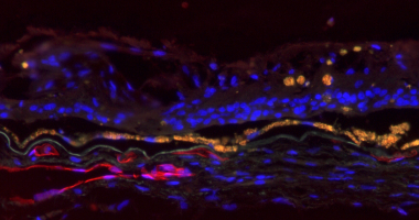 Section of an eye with ABCA4 disease showing cell nuclei (blue), blood vessels (red) and RPE (yellow). Note the loss of photoreceptor cells, the regional preservation of the RPE, and the persistent inner retinal cells. Section of an eye with ABCA4 disease showing cell nuclei, blood vessels and RPE.