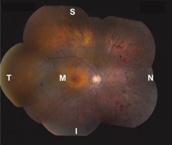 Image of a retina affected with MAK-associated retinitis pigmentosa. Note the more severe degeneration in nasal (N) and inferior (I) regions, compared to macular, superior or temporal retina (M, S, T, respectively).