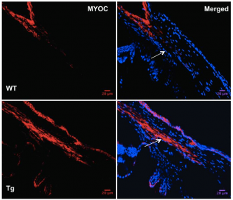 Transgene (Y437H MYOC) and WT MYOC expression were examined in 6-month-old WT and Tg-MYOC-Y437H littermates. Immunostaining revealed that MYOC was localized to TM and is increased in Tg-MYOC-Y437H mice (bottom panels) compared with WT littermates (top panels). The trabecular meshwork is shown by the arrow. Transgene (Y437H MYOC) and WT MYOC expression were examined in 6-month-old WT and Tg-MYOC-Y437H littermates. Immunostaining revealed that MYOC was localized to TM and is increased in Tg-MYOC-Y437H mice (bottom panels) compared with WT littermates (top panels). The trabecular meshwork is shown by the arrow.