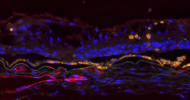 Section of an eye with ABCA4 disease showing cell nuclei, blood vessels and RPE.