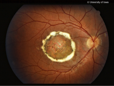 Color fundus photo from a patient with North Carolina Macular Dystrophy Color fundus photo from a patient with North Carolina Macular Dystrophy
