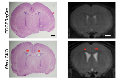 Conditional knockout of Bbs1 in NG2+PDGFRα+ progenitors causes neonatal hydrocephalus. (Left) Representative histology of P3 PDGFRαCre (control) and Bbs1CKO pups showing dilated lateral ventricles of Bbs1CKO mice (red asterisks). (Right) Representative T2-weighted MRIs of 3 month old PDGFRαCre and Bbs1CKO mice showing dilated ventricles in Bbs1CKO mice (red asterisks).