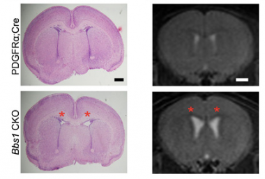 Conditional knockout of Bbs1 in NG2+PDGFRα+ progenitors causes neonatal hydrocephalus. (Left) Representative histology of P3 PDGFRαCre (control) and Bbs1CKO pups showing dilated lateral ventricles of Bbs1CKO mice (red asterisks). (Right) Representative T2-weighted MRIs of 3 month old PDGFRαCre and Bbs1CKO mice showing dilated ventricles in Bbs1CKO mice (red asterisks). Conditional knockout of Bbs1 in NG2+PDGFRα+ progenitors causes neonatal hydrocephalus. (Left) Representative histology of P3 PDGFRαCre (control) and Bbs1CKO pups showing dilated lateral ventricles of Bbs1CKO mice (red asterisks). (Right) Representative T2-weighted MRIs of 3 month old PDGFRαCre and Bbs1CKO mice showing dilated ventricles in Bbs1CKO mice (red asterisks).